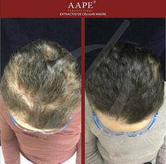 Alopecia - Dra. Dafne Arellano Montalvo