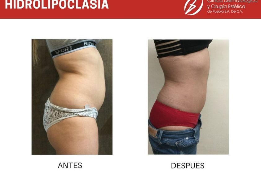 Hiperhidrosis antes y después - 787145