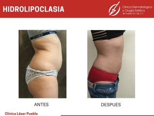 Hiperhidrosis - Dra. Dafne Arellano Montalvo