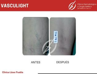 Cirugía varices - Dra. Dafne Arellano Montalvo