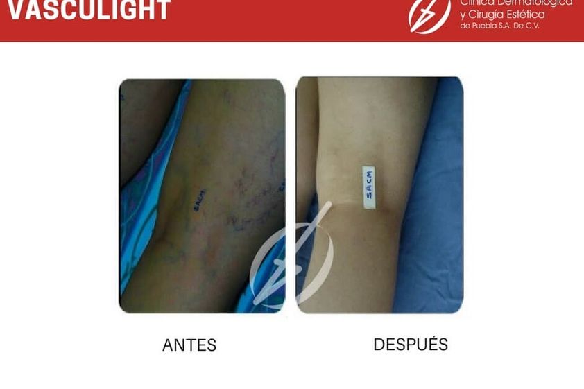 Cirugía varices antes y después - 787224