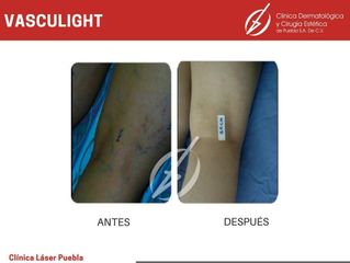 Cirugía varices - Dra. Dafne Arellano Montalvo