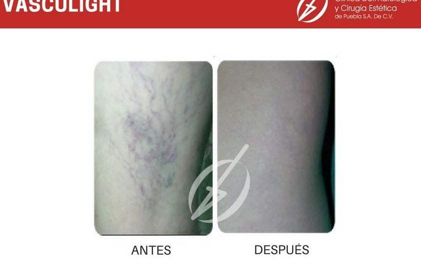 Cirugía varices antes y después - 787227