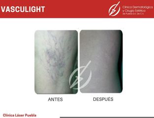 Cirugía varices - Dra. Dafne Arellano Montalvo