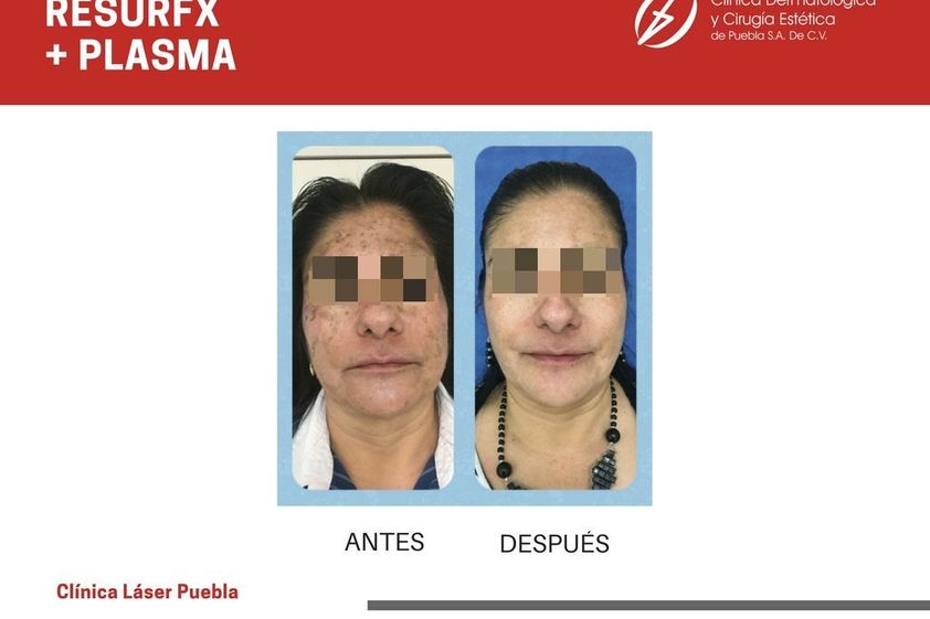 Plasma Rico en Plaquetas antes y después - 788048