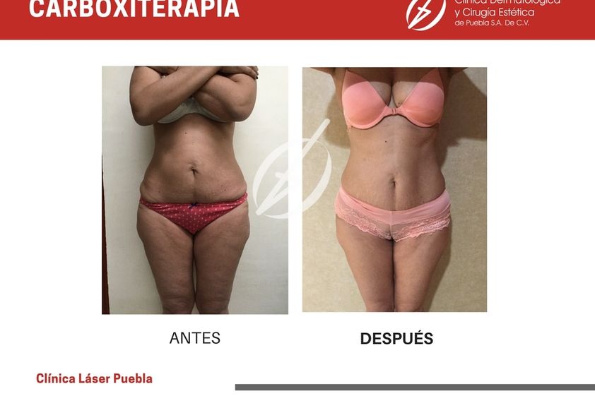 Carboxiterapia antes y después - 788051