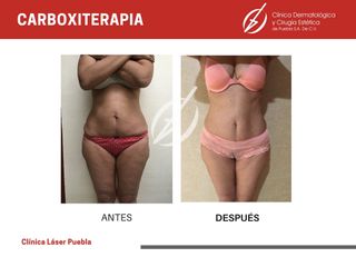Carboxiterapia - Dra. Dafne Arellano Montalvo