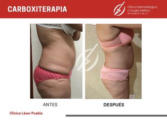 Carboxiterapia antes y después - 788053