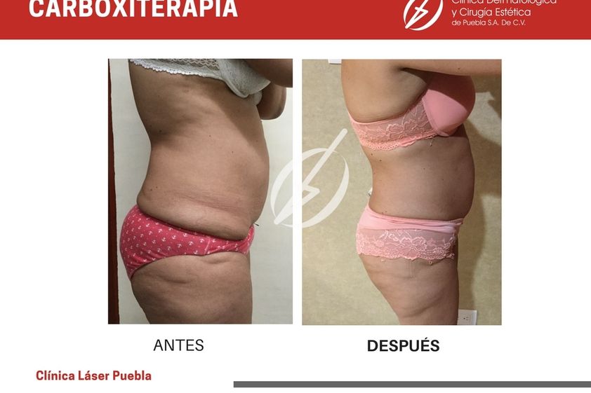 Carboxiterapia antes y después - 788053