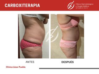 Carboxiterapia - Dra. Dafne Arellano Montalvo