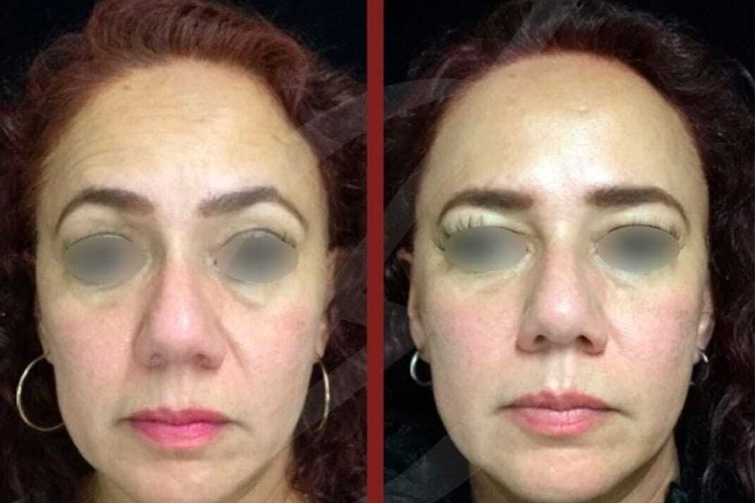 Hilos tensores antes y después - 793637