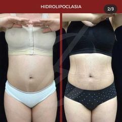 Hidrolipoclasia - Dra. Dafne Arellano Montalvo