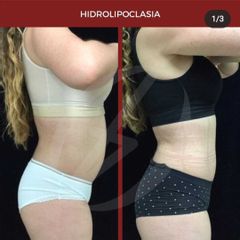 Hidrolipoclasia - Dra. Dafne Arellano Montalvo