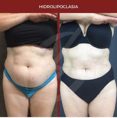 Hidrolipoclasia - Dra. Dafne Arellano Montalvo