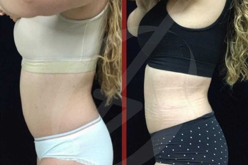 Tratamientos anticelulíticos antes y después - 793644