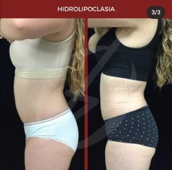 Hidrolipoclasia - Dra. Dafne Arellano Montalvo