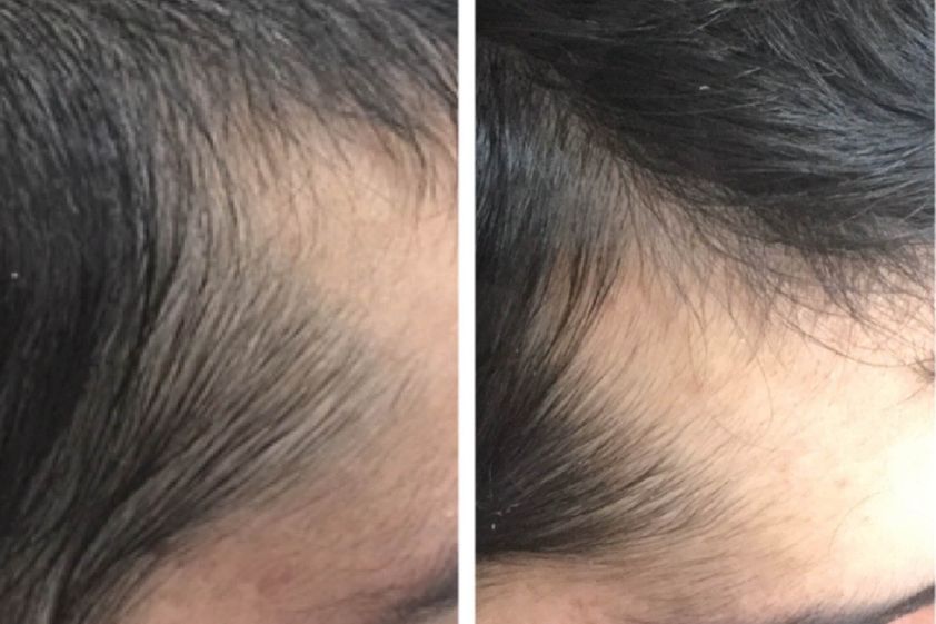 Plasma Rico en Plaquetas antes y después - 872029