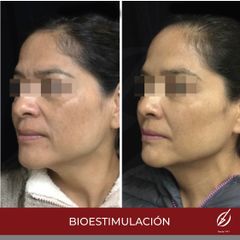 Bioestimulación - Dra. Dafne Arellano Montalvo