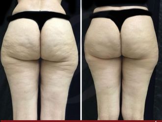 Tratamientos anticelulíticos antes y después - 872032