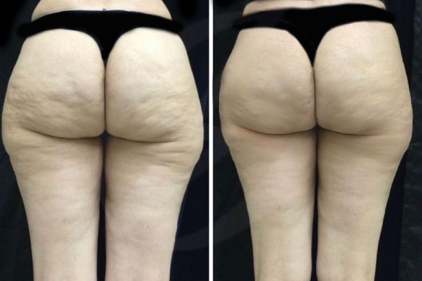 Tratamientos anticelulíticos antes y después - 872032