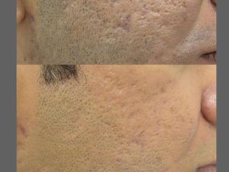 Láser CO2 Fraccionado antes y después - 877630