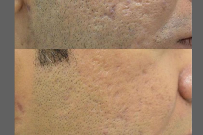 Láser CO2 Fraccionado antes y después - 877630