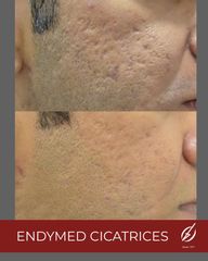 Cicatrices Endymed - Dra. Dafne Arellano Montalvo