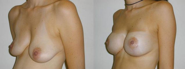 Antes y después de Mastopexia