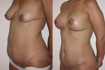 Antes y después de Abdominoplastia
