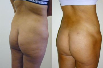 Antes y después de Gluteoplastia