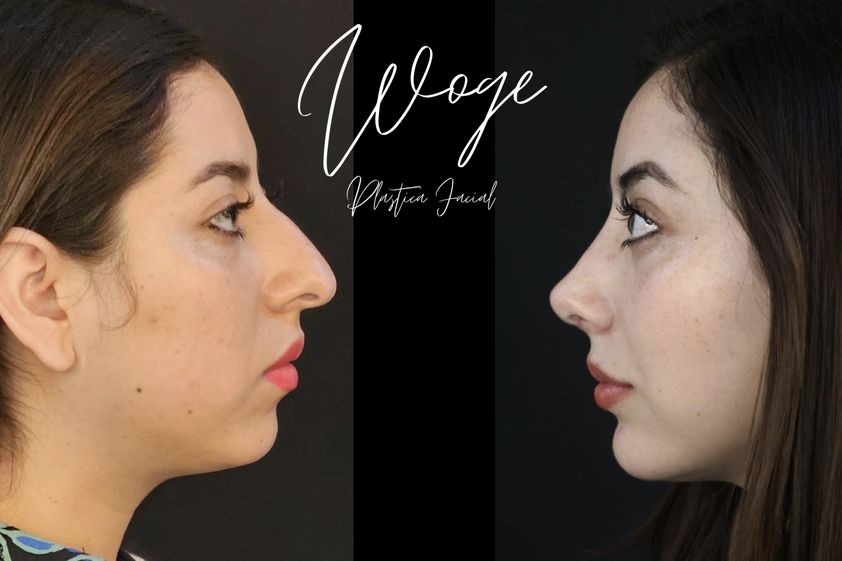 Mentoplastia antes y después - 873620