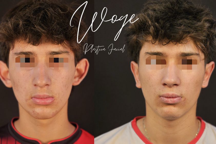 Otoplastia antes y después - 873624