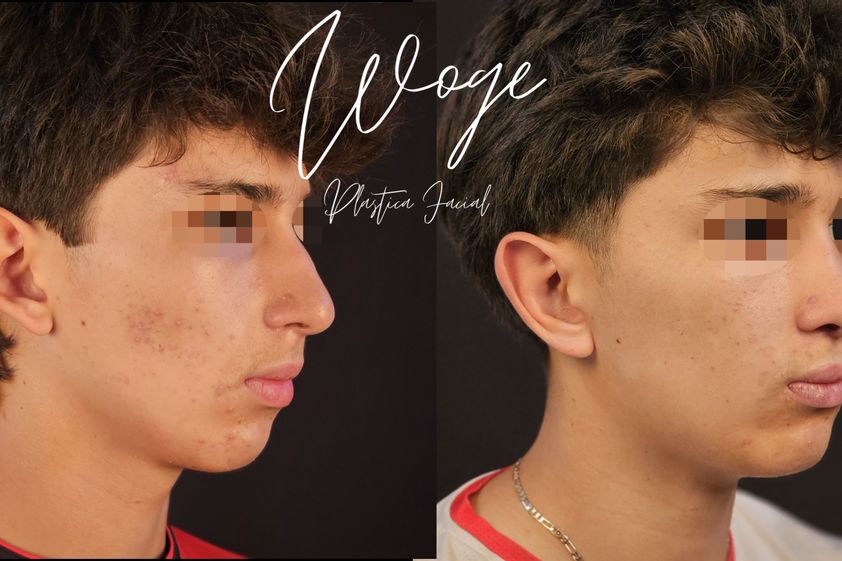 Otoplastia antes y después - 873625
