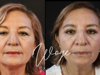 Blefaroplastia antes y después - 873626