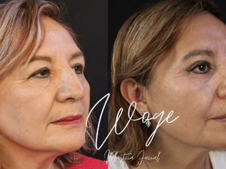 Blefaroplastia antes y después - 873627