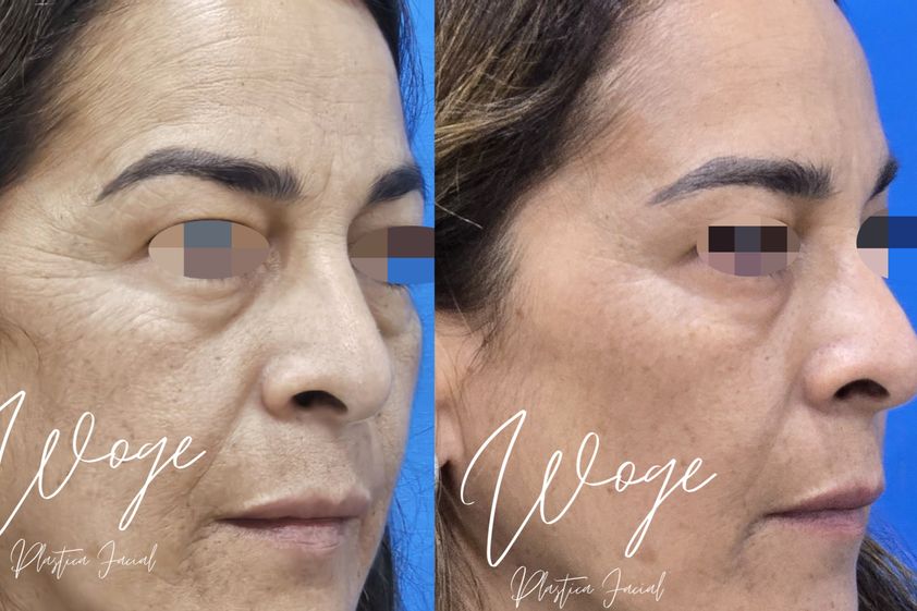 Toxina botulínica antes y después - 873632