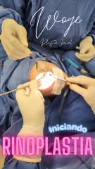 Rinoplastia - Dr. Carlos Woge