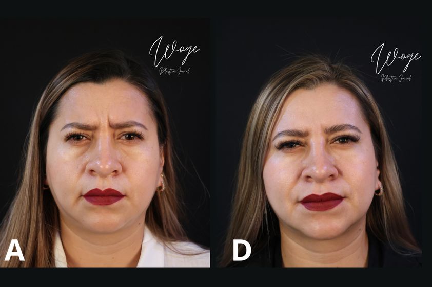 Toxina botulínica antes y después - 873842
