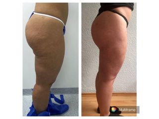 Antes y depués de Skin Medical System 