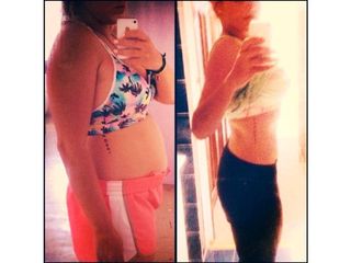 Antes y después de lipólisis Skin Medical System 