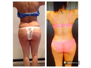 Antes y después de tratamientos anticelulíticos  Skin Medical System 