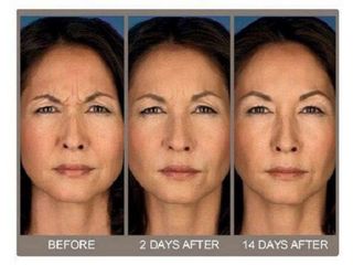 Antes y después de rejuvenecimiento facial Skin Medical System 