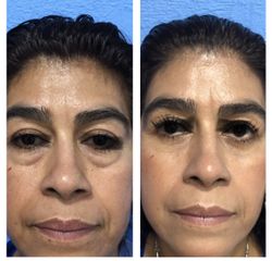 Antes y después de  Blefaroplastia 