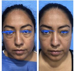 Antes y después de  Blefaroplastia 