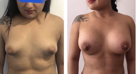 Antes y después de Aumento de Busto