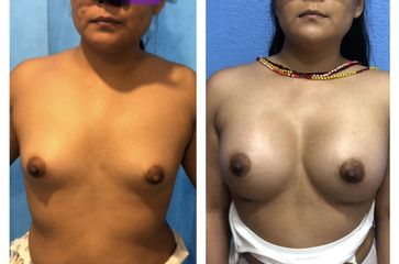 Antes y después de Aumento de Busto 