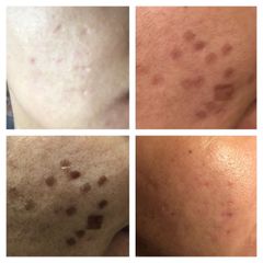 Antes y depués de Corrección de cicatrices - Skin Medical System