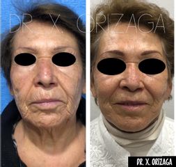 Antes y depués de Rejuvenecimiento facial - Skin Medical System