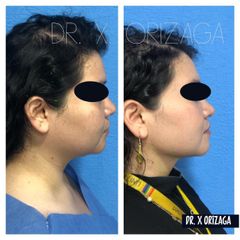 Antes y depués de Cirugía de papada - Skin Medical System