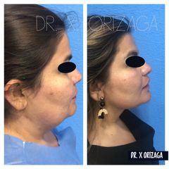 Antes y depués de Cirugía de papada - Skin Medical System